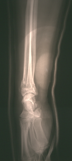 post-reduction-side
