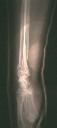 Post reduction side view